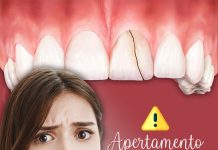 Saúde bucal: O apertamento pode levar ao trincamento dos dentes. Dra Larissa Tessarini