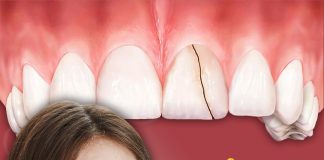 Dra Larissa Tessarini: O apertamento e o perigo dos dentes trincados