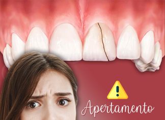 Dra Larissa Tessarini: O apertamento e o perigo dos dentes trincados