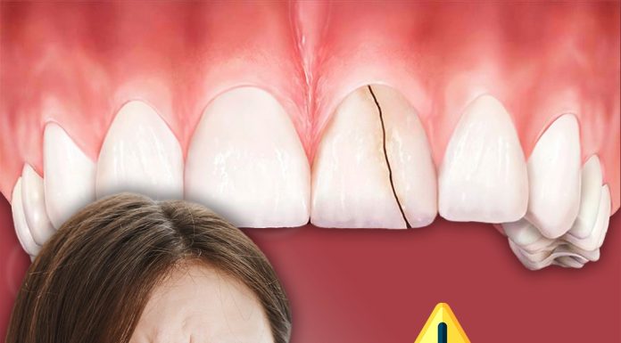 Dra Larissa Tessarini: O apertamento e o perigo dos dentes trincados